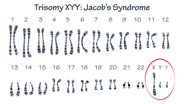 Jacob's syndrome trisomy 47 XYY genetic condition