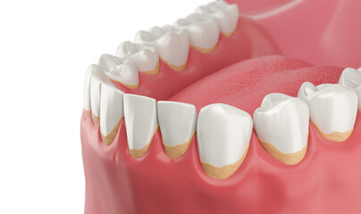 Dental plaque and Tartar,Teeth Cleaning dental care concept 3d rendering.