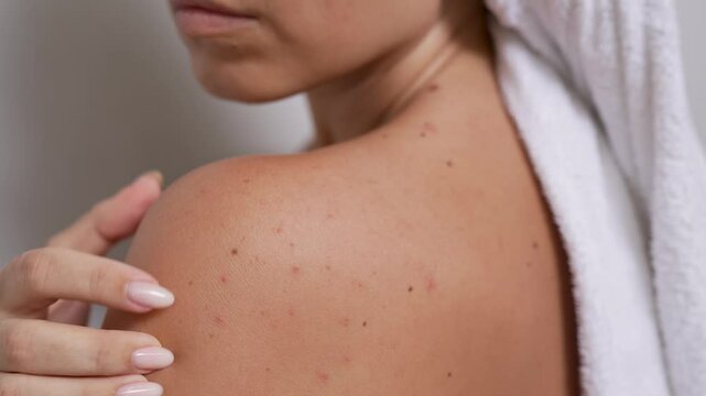 Close-up of a red rash on female shoulder. Young woman touching her back with acne problem. Allergies, pimples, hormonal changes. Problem skin, sweating sickness, prickly heat. Dermatology concept