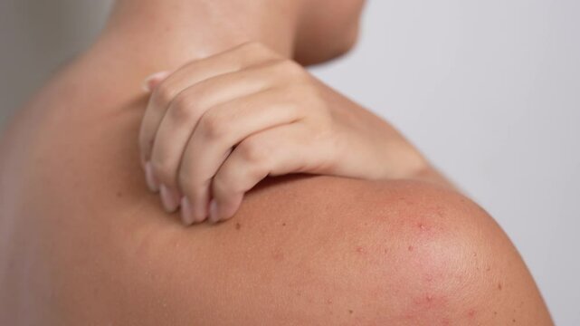 Close-up of a red rash on female body. Young woman scratching her shoulder and back with acne problem. Allergies, pimples, hormonal changes. Problem skin, sweating sickness, prickly heat. Dermatology