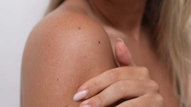 A young blonde woman scratches peeling sunburned skin on her shoulder with her nails, close-up. The image captures the texture of dry, damaged skin and the process of exfoliation after sun exposure