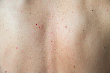Close-up of a person's back with visible acne, freckles, and skin texture, highlighting natural...