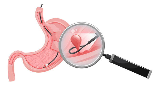 Removal polyp in stomach. Enlarged view of endoscope grasping polyp with loop. Vector medical illustration.