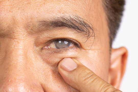 Senior man has cataract. Generally, cataracts are common in older people.