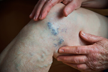 Elderly woman showing varicose veins on her leg close-up. Healthcare concept