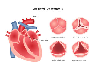 Aortic valve stenosis. Medical illustration of heart disease with image of heart show location of aortic valve, healthy and diseased valve in open and closed state. Vector illustration in flat style