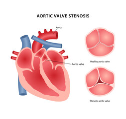 Aortic valve stenosis. Medical illustration of heart disease with image of heart showing location of aortic valve, healthy and diseased valve in closed state. Vector illustration in flat style