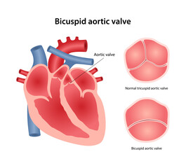 Bicuspid aortic valve, congenital heart defect. Medical illustration of human heart showing location of aortic valve, healthy and defective valve. Vector illustration in flat style
