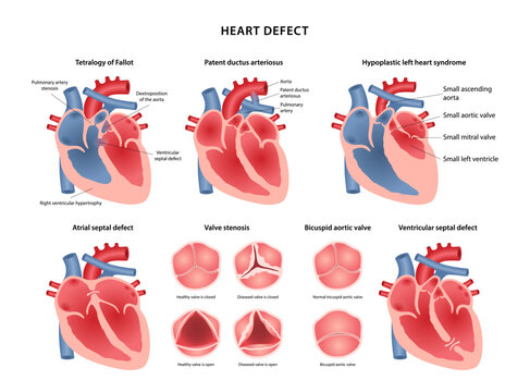 Heart defect. Medical illustration of atrial and ventricular septal defects, tetralogy of Fallot, patent ductus arteriosus, hypoplastic left heart syndrome, valves stenosis. Vector illustration