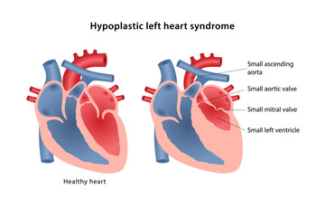 Hypoplastic left heart syndrome, congenital heart defect. Medical illustration of defective heart with small aorta, aortic valve, mitral valve, left ventricle. Vector illustration in flat style.