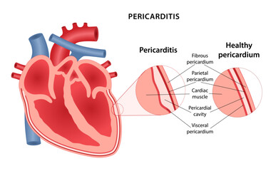Pericarditis, inflammation of the lining of the heart. Medical illustration of human heart with an enlargement of the pathological area of ​​lining of heart. Vector illustration in flat style