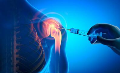 Anatomy human shoulder joint Osteoarthritis treatment, drug injection - 3d illustration