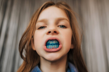 Photo, portrait of the face of a beautiful smiling girl child with a blue silicone denture, a mouth...