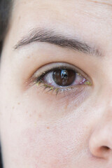 Obraz premium Close-up of an infected eye with redness and yellow discharge, symptoms of bacterial conjunctivitis, irritated and swollen look, medical condition, ophthalmology, eye health, vertical