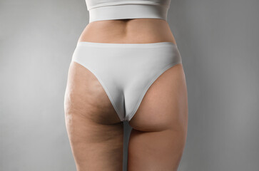 Cellulite treatment, before and after collage. Young woman showing her buttocks and thighs on grey...