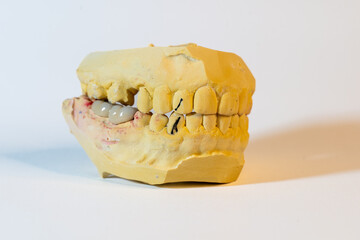 Dental stone model showing the upper and lower jaws clenched, and a metal porcelain denture...