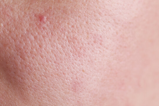 Texture of skin with enlarged pores as background, closeup