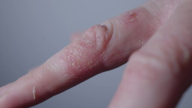 scary hideous looking skin hand affected with skin disease. scabs dry redness flaking inflammation reaction on allergy food intestine problems health concept. 