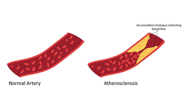 Atherosclerosis on artery vector illustration