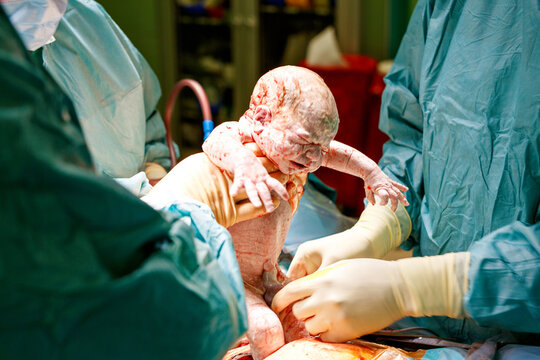 Baby being born via Caesarean Section coming out.