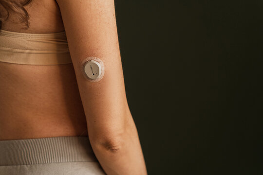 MINSK, BELARUS - MARCH 11, 2025: blood sugar monitor on her arm. Dexcom One Plus. Life with diabetes
