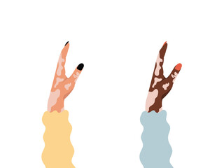 Sowing on the Human Hand Vitiligo world vitiligo day. Skin disease. Self care and self love. Vector illustration