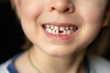 Portrait of little boy with open mouth without one front milk tooth. Loss of baby primary teeth. Waiting for growth of permanent molar tooth.