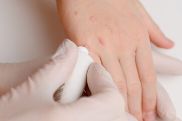 Dermatologist in medical gloves applies special product to child's hand affected by warts from papillomavirus, close-up. Verruca vulgaris. Papillomavirus, HPV. Skin diseases, getting rid of warts