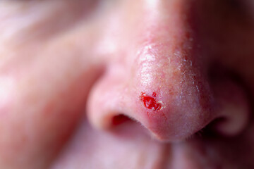 Fototapeta premium Health care concept, Close up of man nose with red spot and blood after biopsy, Wound on tip of nose, Basal-cell carcinoma (BCC) also known as basal-cell cancer is the most common type of skin cancer.