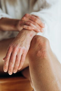 Sick person. Unrecognizable young woman suffering from autoimmune incurable dermatological skin disease called psoriasis. Large red inflamed scaly rash on elbows. joints affected by psoriatic arthriti