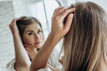 Fototapeta premium Sick person. Unrecognizable young woman suffering from autoimmune incurable dermatological skin disease called psoriasis. Large red inflamed scaly rash on elbows. joints affected by psoriatic arthriti