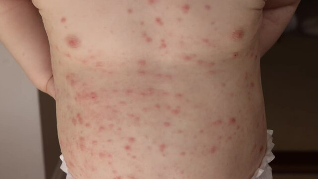 A young child with severe chicken pox illness covered in spots and blisters.