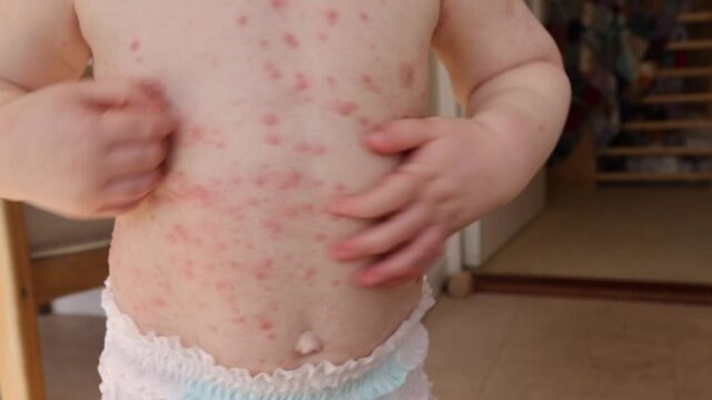 A young child with severe chicken pox illness covered in spots and blisters.