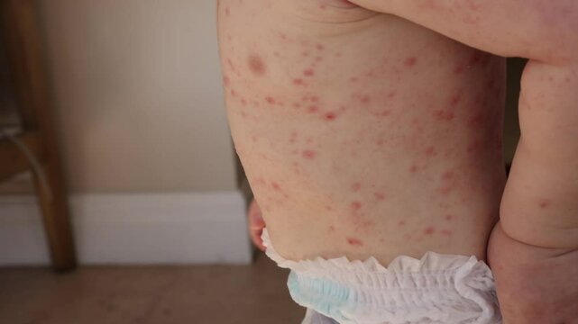 A young child with severe chicken pox illness covered in spots and blisters.