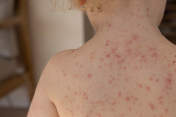 Fototapeta premium A young child with severe chicken pox illness covered in spots and blisters