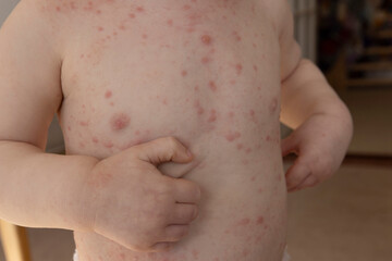 Fototapeta premium A young child with severe chicken pox illness covered in spots and blisters