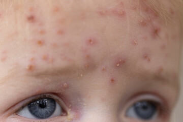 A young child with severe chicken pox illness covered in spots and blisters