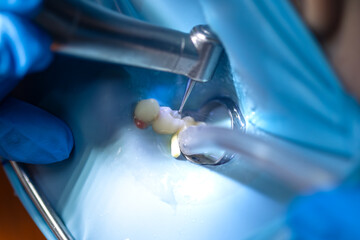 The dentist treats the child's tooth using a rubber dam. Close-up of tooth treatment.