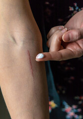 A scratch on a woman hand. Selective focus.