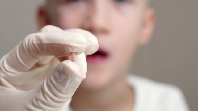 Doctor in gloves holds small extracted baby tooth in his hands against background of child, close-up. Baby teeth are replaced by permanent ones. Pediatric dentistry, children's dental care. Tooth loss