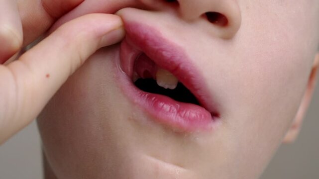 Child lifts his lip with his finger, showing hole from fallen baby tooth, close-up. Baby teeth are replaced by permanent ones. Pediatric dentistry