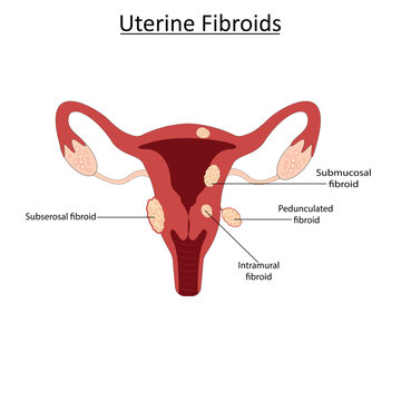 Uterine fibroids vector illustration