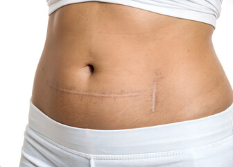 cesarean section scar on a young girl's stomach