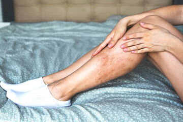 Close-up of a woman's legs with skin pigmentation issues, showing discoloration and uneven tone, as...