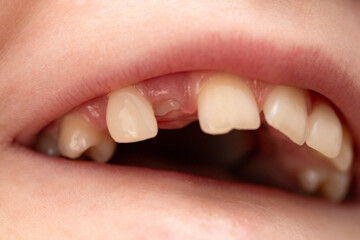 Orthodontist examining kid mouth. The tooth is growing in the wrong place