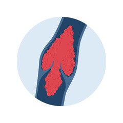 Deep vein thrombosis for healthcare infographic. Vector flat character illustration. Vascular disease diagnostic and treatment. Blood clot block vein in valve. Design for health care, education