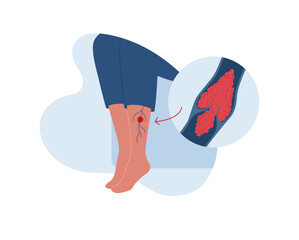 Deep vein thrombosis for healthcare infographic. Vector flat character illustration. Vascular disease diagnostic and treatment. Blood clot block vein in female leg. Design for health care, education