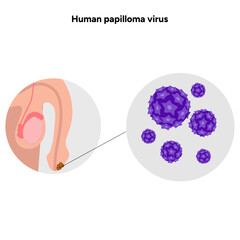 Human papilloma virus in zoom view in human reproductive system. Hpv in human