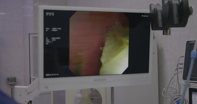 The veterinary clinic uses advanced technologies, gastroscopy to extract an extraneous object from the stomach of the cat, ensuring its well -being and recovery. Gastroscopy at the cat.
