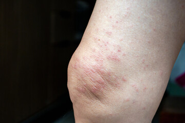 Fototapeta premium Skin diseases, skin allergies in women, itchy rash, dermatitis, skin texture of patients